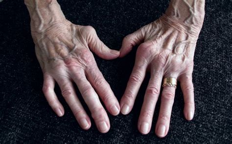 tratamentul artritei reumatoide degetele de la picioare